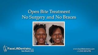 Open Bite Treatment - No Surgery and No Braces