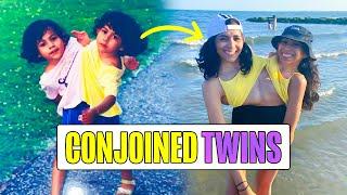 Life As Teenage Conjoined Twins - Meet Carmen & Lupita