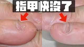 Severe nail strain｜Nails are almost gone｜Nails grow back after gel protection