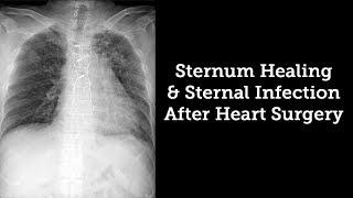 Sternum Healing & Sternal Infection Rates After Heart Surgery with Dr. Steve Bolling