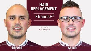 Amazing  non-surgical hair loss solution | Male hair loss & hair replacement choice