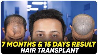 Hair Transplant in Istanbul | Best Results & Cost of Hair Transplant in Istanbul