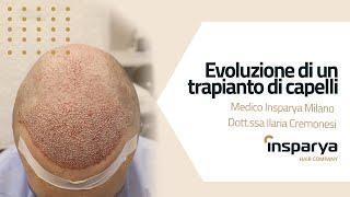 Evoluzione di un Trapianto di Capelli