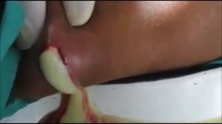 Very very big cyst infected - Du pue sort en abondance du kyste