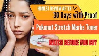 Truth About Pokonut Stretch Mark Toner Unveiled | Honest Review | Stretch marks removal PART-2