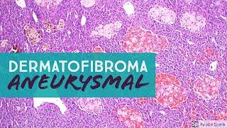 Dermatofibroma, Aneurysmal Type (Aneurysmal Benign Fibrous Histiocytoma) pathology dermpath