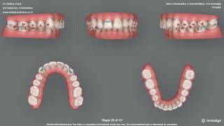 Invisalign Treatment Plan