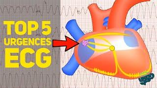  Le TOP 5 des Urgences à l'Ecg EXPLIQUÉES CLAIREMENT ! ​