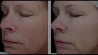 Microneedling Revitalizes Your Skin