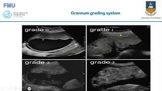 Relationship between Placenta grade and Uterine Artery Dopplers in FGR Fetuses - Sheila Kanyimo