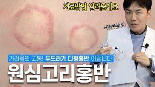 극심한 가려움의 고통! 원심고리홍반 치료방법 | 두드러기 다형홍반 아니에요 |연세에이엔비피부과 이해진 원장