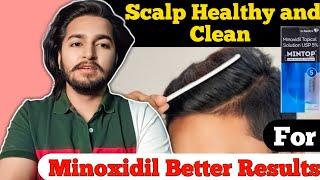 Minoxidil Better Results If Your Scalp Is Healthy Or Clean | Sahil Nagpal