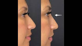 Non-Surgical Nose Job / Nose Filler from Dr. Tsay - Ageless MD