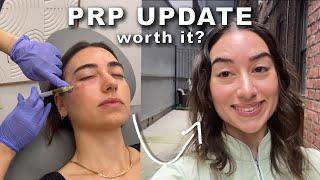 6 Month PRP Under Eye Update