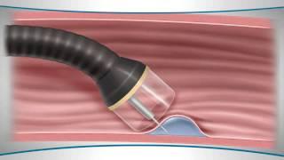 Learn About an Endoscopic Mucosal Resection