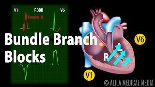 Bundle Branch Block, Animation.