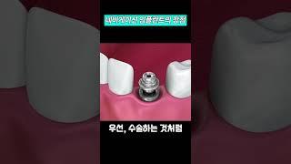 네비게이션 임플란트란?