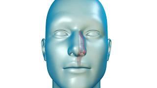 A Solution for Nasal Airway Obstruction