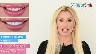 E-Max Veneers - Sammy B. (Samantha Blackman)