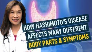 How Hashimoto's Disease Affects Many Body Parts & Symptoms. Maggie Yu, MD:
