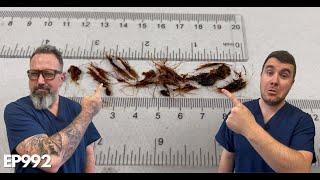 INSANE Amount Of Hair Removed From My Ear Canal - EP992