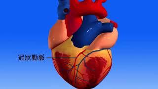 動畫22.2 冠心病的成因