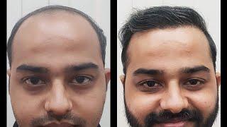 Hair Transplant Results @ The Hair and Shape Clinic,