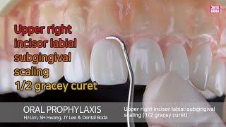 Upper right incisor labial subgingival scaling 1/2 gracey curet