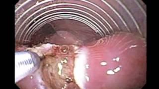 Zenker's Diverticulum: endoscopic septotomy