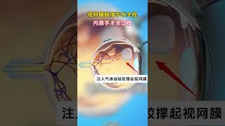 今天一条视频带你了解视网膜脱落 内路手术全过程！动画展示 眼底手术 科普一下