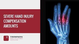 Severe Hand Injury Compensation Amounts