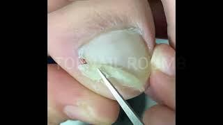 The Big Ingrown Toenail Treatment Tutorial #tonailroomb