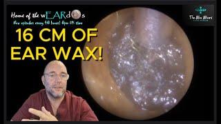 16 CM OF EAR WAX! 199 #ear #earwax #earwaxremoval #earcleaning #asmr #asmrearwax #satisfying