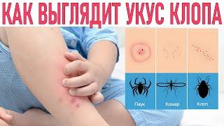 УКУС КЛОПА | Как он выглядит и чем его смазывать и как избавиться от клопов