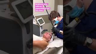 Laser Resurfacing with Lutronic Ultra -- All The Benefits of Laser With Virtually No Downtime