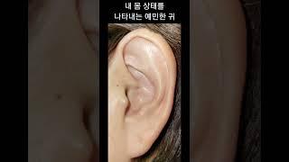 이혈요법,이침,귀생활건강법
