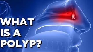 What is a POLYP? || Sleep and Sinus Centers of Georgia