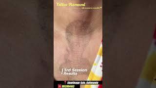 Transform Your Skin: Tattoo Removal Before and After! #tattooremoval #lasertattooremoval #akarshan