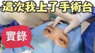 「縫雙眼皮」全程實錄，怕者勿入，這次我上了手術台！