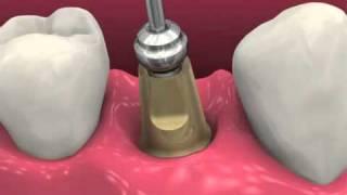 Restoring BioHorizons Dental Implants (2011)