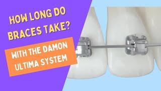 How Long Do Braces Take With The Damon Ultima System?