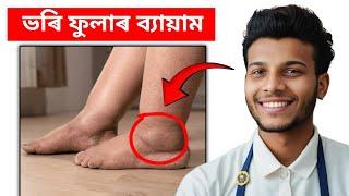 Foot Swollen Physiotherapy Exercise in Assamese @PonkhiSharma @DevottomAxom