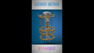 ILIZAROV method | Complete Surgical Demonstration