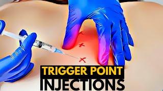 The Anatomy of Pain Relief: A Look at Trigger Point Injections