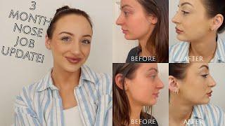 3 MONTH RHINOPLASTY UPDATE! Swelling, Pain, Numbness, etc!