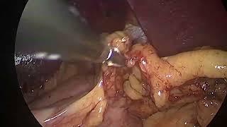 Laparoscopic fundoplication surgery; for /Hiatus hernia/‘heartburn surgery’ and ‘reflux operation’