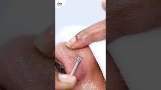 Summer-Ready with Melanin Break Therapy | VCare Hair & Skin Clinic #vcare #skincare #suntan