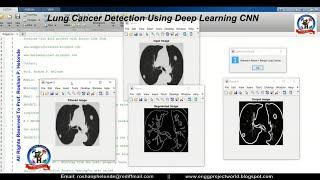 Lung Cancer Detection Using Deep Learning CNN | Lung Cancer Classification Using Matlab Project