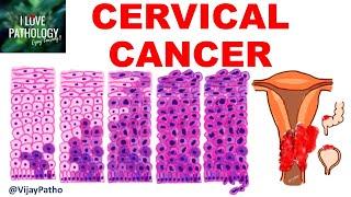 Squamous Intraepithelial lesion & CANCER   CERVIX