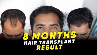 Best Hair Transplant in India | Best Results & Cost of Hair Transplant in India